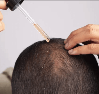 Finasterid kontra Minoxidil: spolu alebo samostatne?