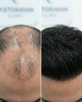 Kedy uvidím výsledok transplantácie vlasov ?