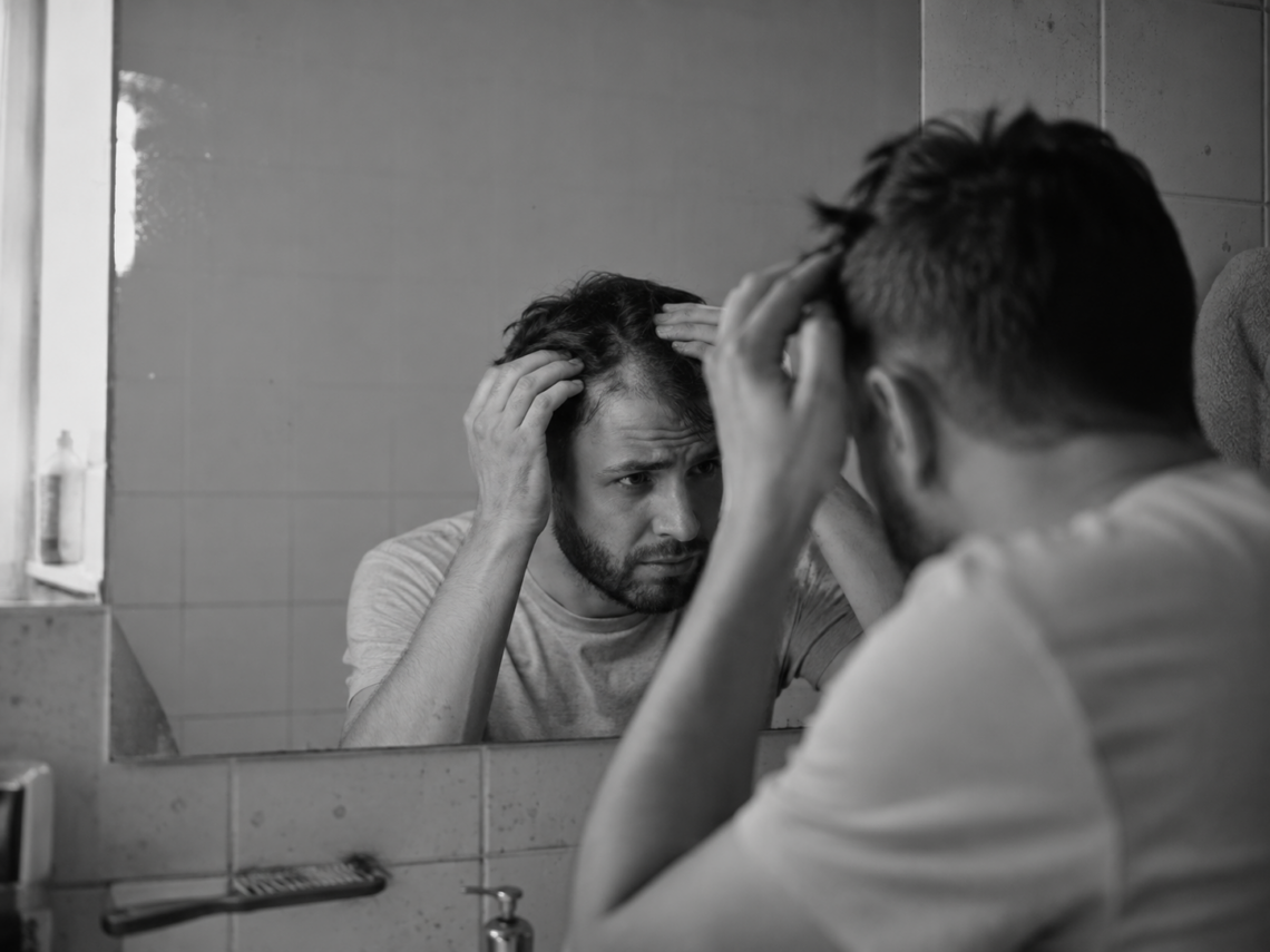 Nie je to vysoký testosterón. Je to citlivosť tvojich folikulov na normálne DHT.