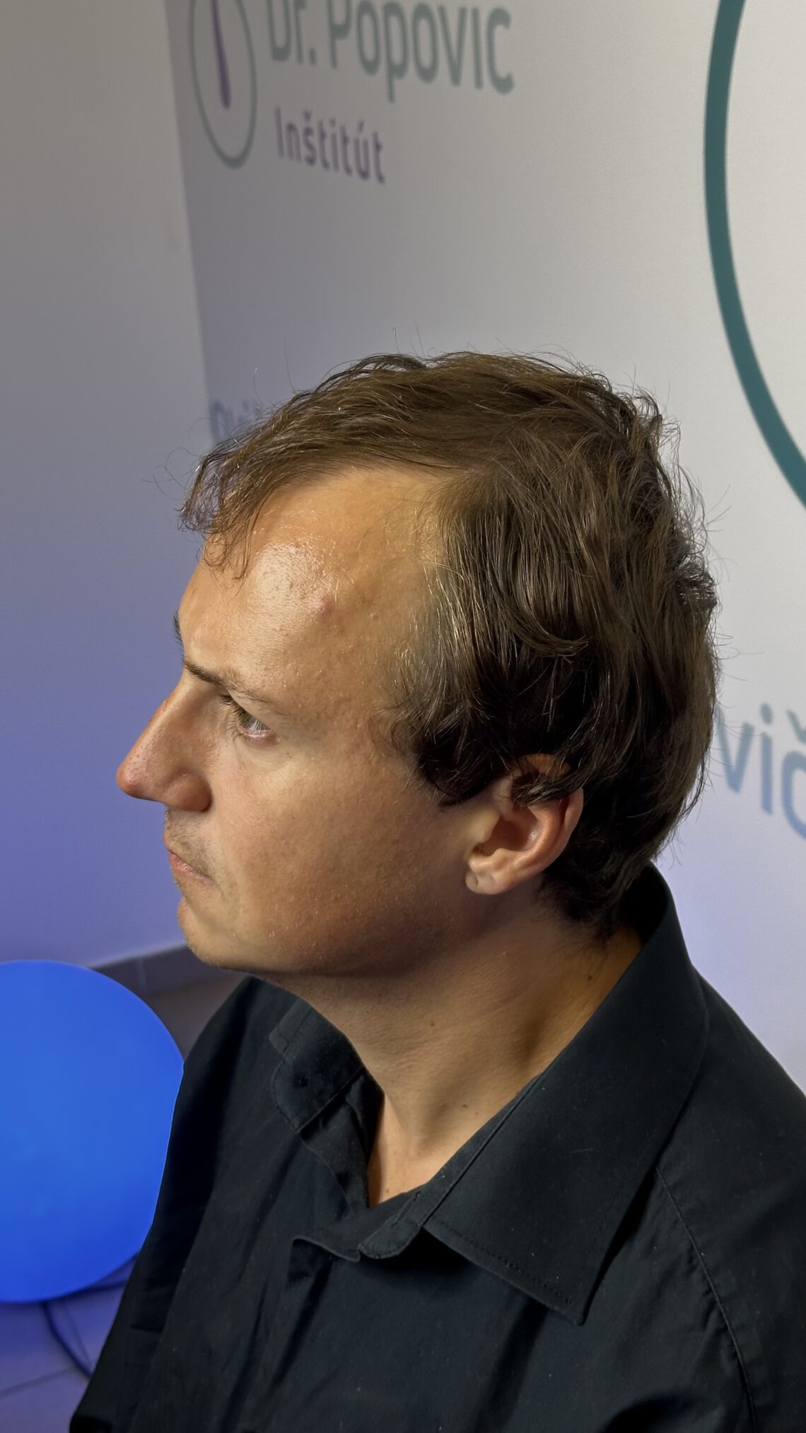 Vypadávanie vlasov a finasterid: čo hovorí veda, nie TikTok